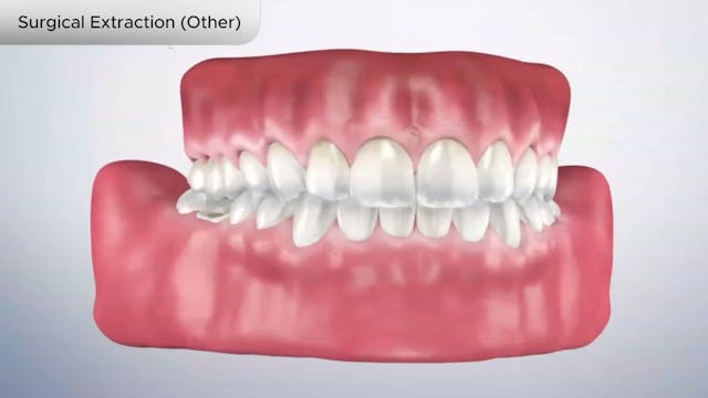 Surgical Extraction (Other) - Dental Patient Education Video