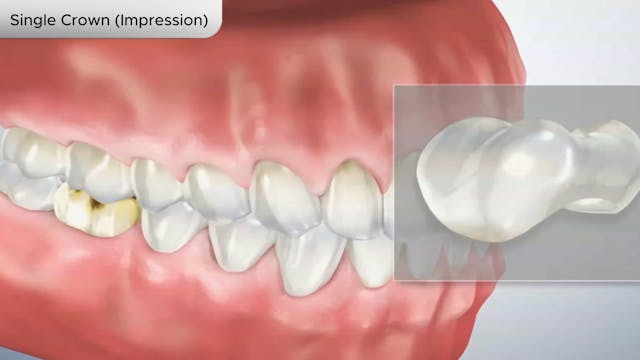 Single Crown (Impression) - Dental Patient Education Video