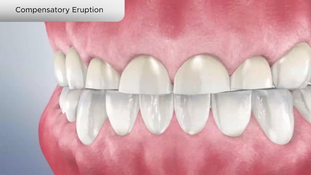 Compensatory Eruption - Dental Patient Education Video