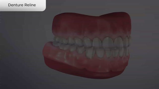 Denture Reline - Dental Patient Education Video