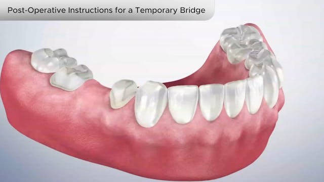 Post-Operative Instructions for Temporary Bridge- Dental Patient Education Video