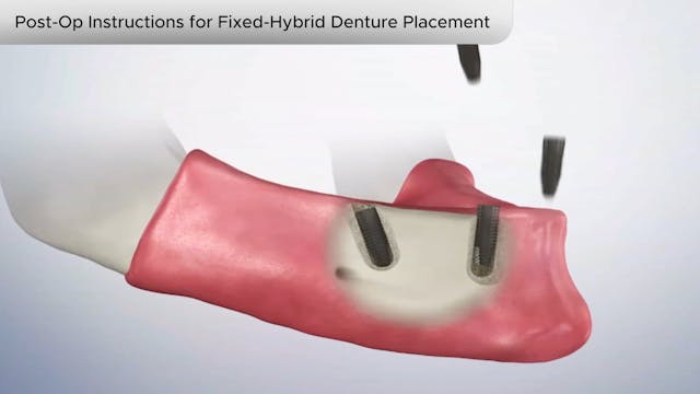 Post-Op Ins Fixed-Hybrid Denture Placement - Dental Patient Education Video