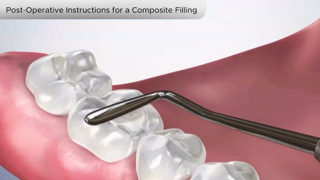 Post-Operative Instructions Composite Filling - Dental Patient Education Video