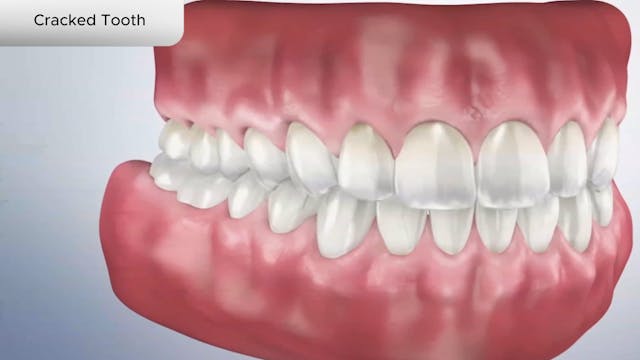 Cracked Tooth - Dental Patient Education Video