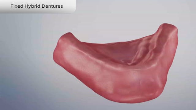 Fixed Hybrid Dentures - Dental Patient Education Video