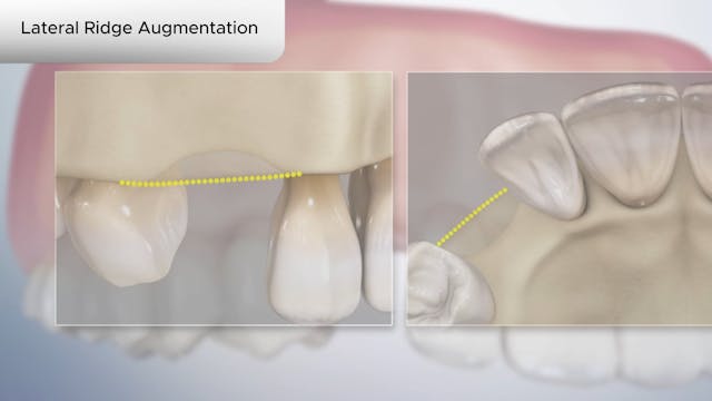 Lateral Ridge Augmentation - Dental Patient Education Video