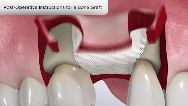 Post-Operative Instructions for a Bone Graft - Dental Patient Education Video