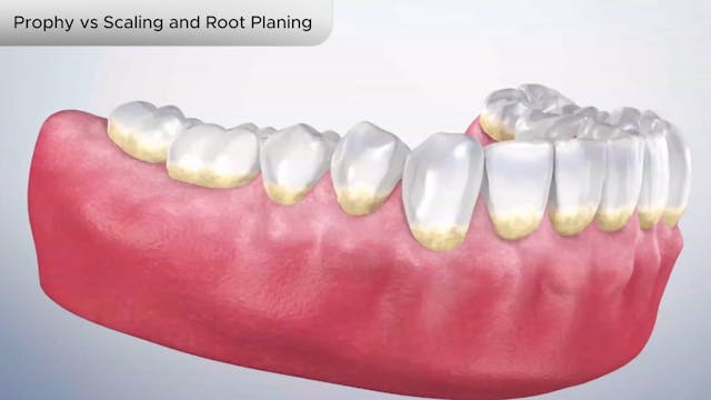 Prophy vs Scaling and Root Planing - Dental Patient Education Video