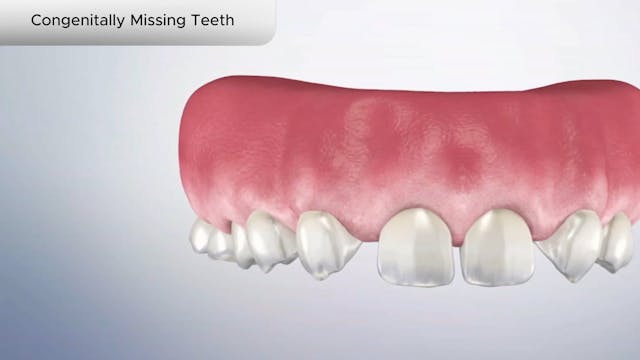 Congenitally Missing Teeth -Dental Patient Education Video