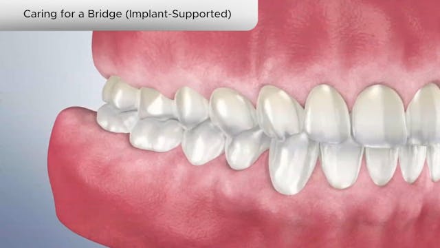 Caring for a Bridge (Implant-Supported) - Dental Patient Education Video