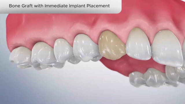 Bone Graft with Immediate Implant Placement - Dental Patient Education Video