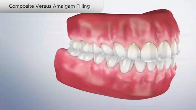 Composite Versus Amalgam Filling - Dental Patient Education Video