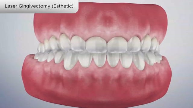 Laser Gingivectomy (Esthetic) - Dental Patient Education Video