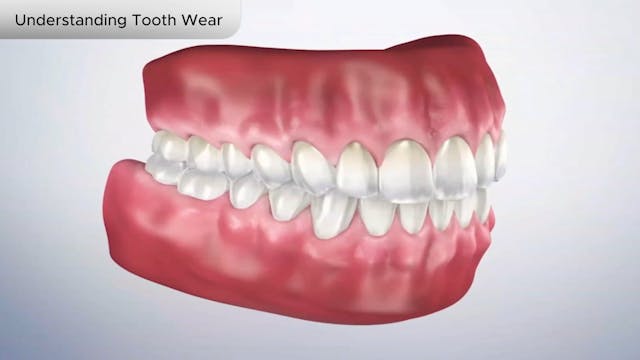 Understanding Tooth Wear