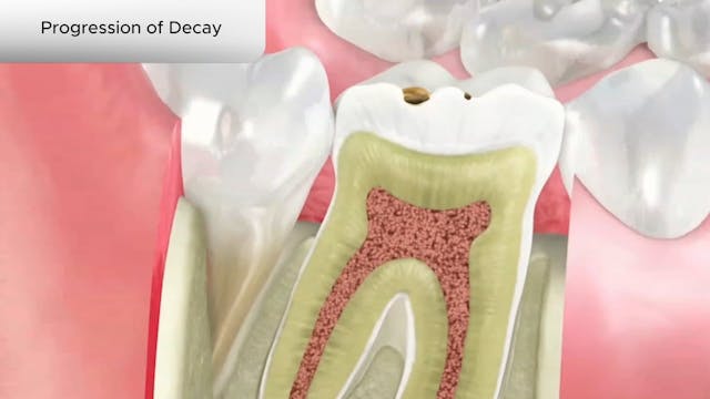 Progression of Decay - Dental Patient Education Video