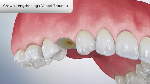 Crown Lengthening (Dental Trauma) - Dental Patient Education Video