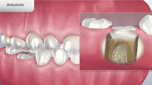 Ankylosis - Dental Patient Education Video