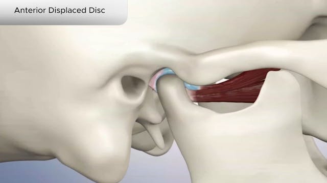 Anterior Displaced Disc - Dental Patient Education Video