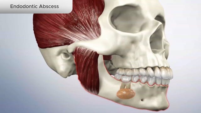 Endodontic Abscess - Dental Patient Education Video