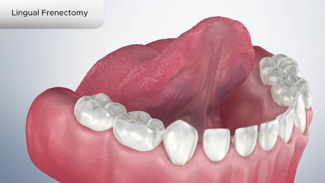 Lingual Frenectomy - Dental Patient Education Video