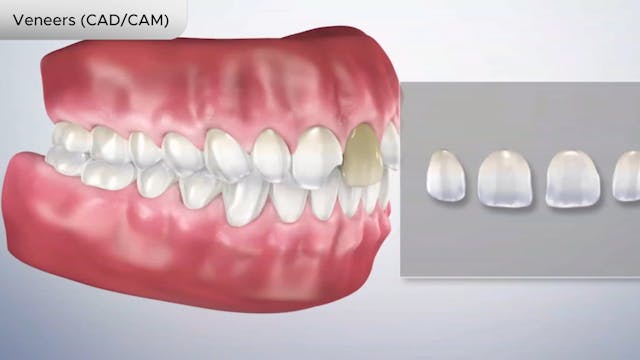 Veneers (CADCAM) - Dental Patient Education Video