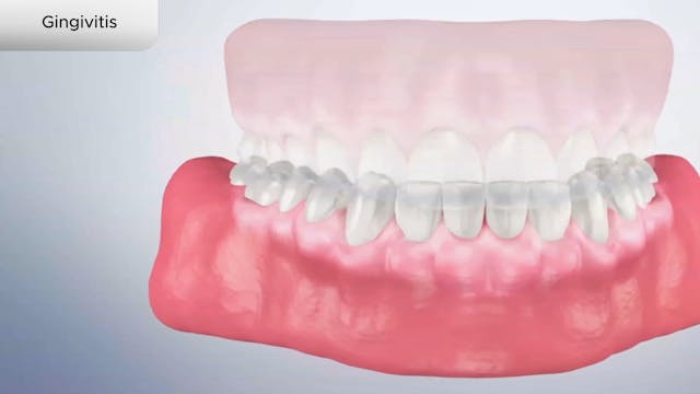 Gingivitis - Dental Patient Education Video