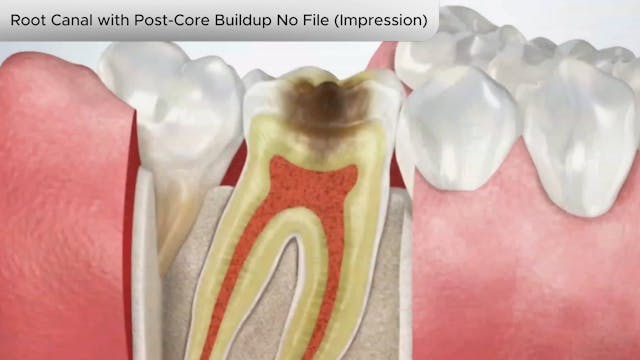 Root Canal Post-Core Buildup No File (Impression)-Dental Patient Education Video