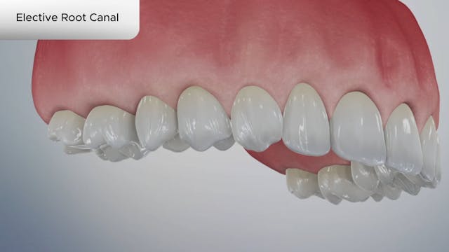 Elective Root Canal - Dental Patient Education Video