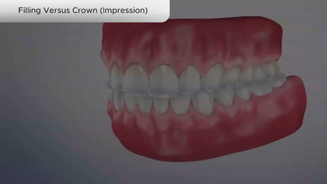 Filling Versus Crown (Impression) - Dental Patient Education Video