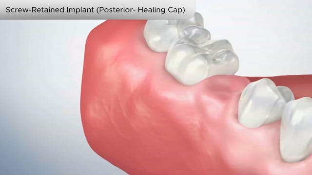 Screw-Retained Implant (Posterior- Healing Cap) - Dental Patient Education Video