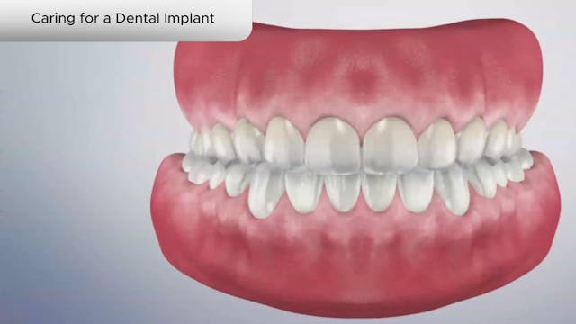 Caring for a Dental Implant - Dental Patient Education Video