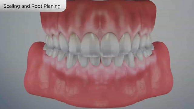 Scaling and Root Planing - Dental Patient Education Video