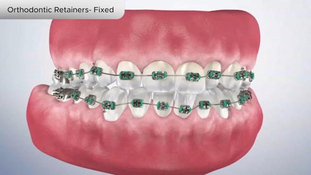 Orthodontic Retainers- Fixed - Dental Patient Education Video