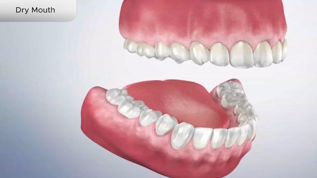 Dry Mouth - Dental Patient Education Video