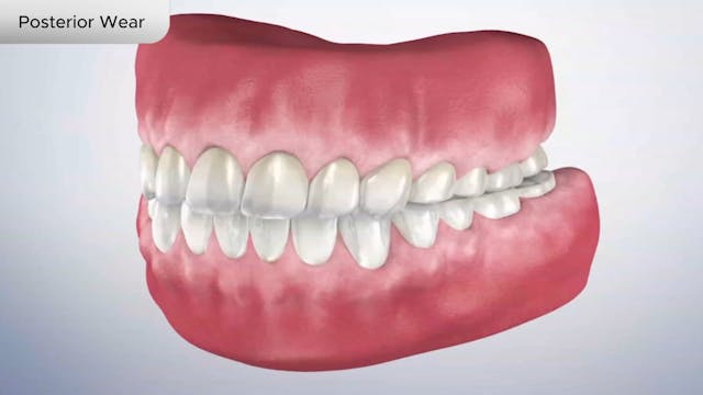 Posterior Wear - Dental Patient Education Video