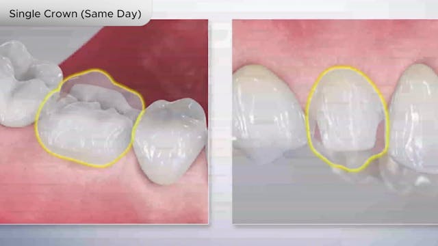 Single Crown (Same Day) - Dental Patient Education Video