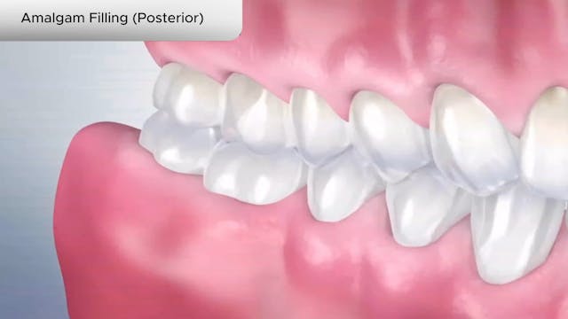 Amalgam Filling (Posterior) - Dental Patient Education Video