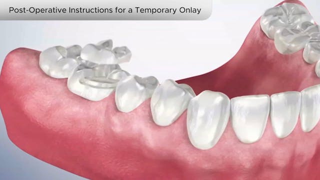 Post-Operative Instructions for Temporary Onlay - Dental Patient Education Video