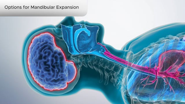 Options for Mandibular Expansion - Dental Patient Education Video