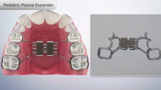 Pediatric Palatal Expander - Dental Patient Education Video