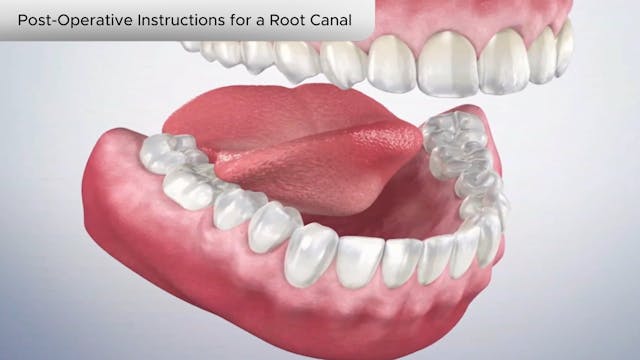 Post-Operative Instructions for a Root Canal - Dental Patient Education Video