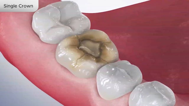 Single Crown - Dental Patient Education Video