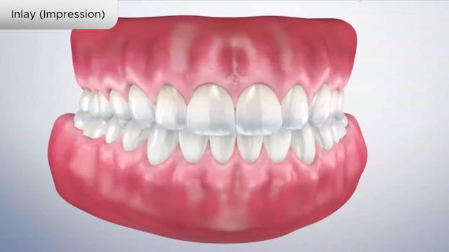 Inlay (Impression) - Dental Patient Education Video