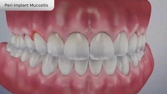 Peri-Implant Mucositis - Dental Patient Education Video