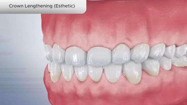 Crown Lengthening (Esthetic) - Dental Patient Education Video