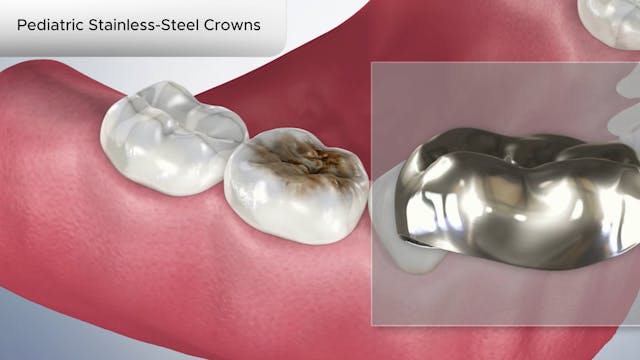 Pediatric Stainless-Steel Crowns - Dental Patient Education Video