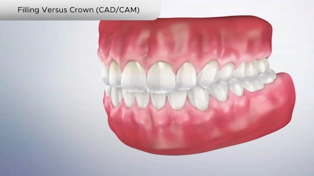 Filling Versus Crown (CADCAM) - Dental Patient Education Video