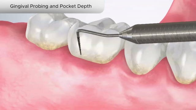 Gingival Probing and Pocket Depth - Dental Patient Education Video