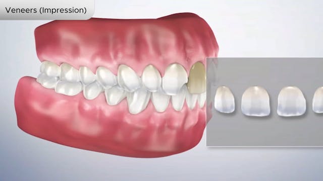 Veneers (Impression) - Dental Patient Education Video