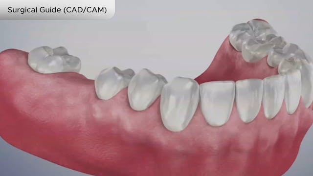 Surgical Guide (CADCAM) - Dental Patient Education Video